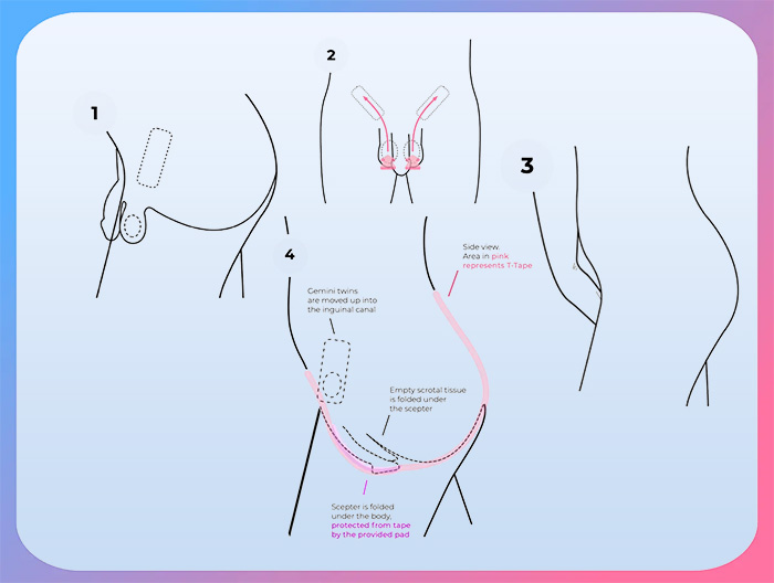 Tucking into Inguinal Canal