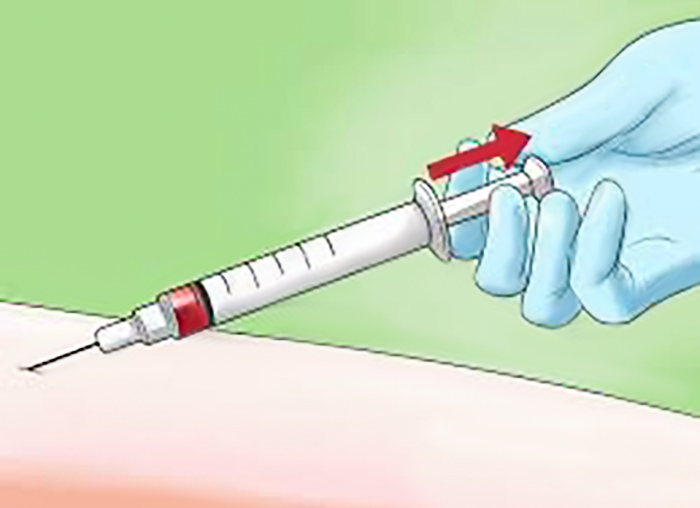 Gently Pull Back the Plunger of the Syringe to Check That the Blood is Not Flowing Back into the Syringe