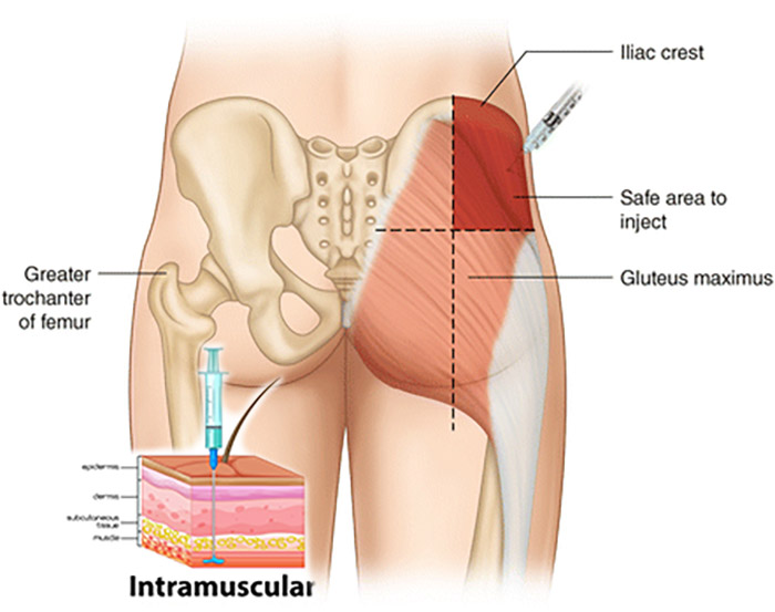 What Is Intramuscular Testosterone Injection