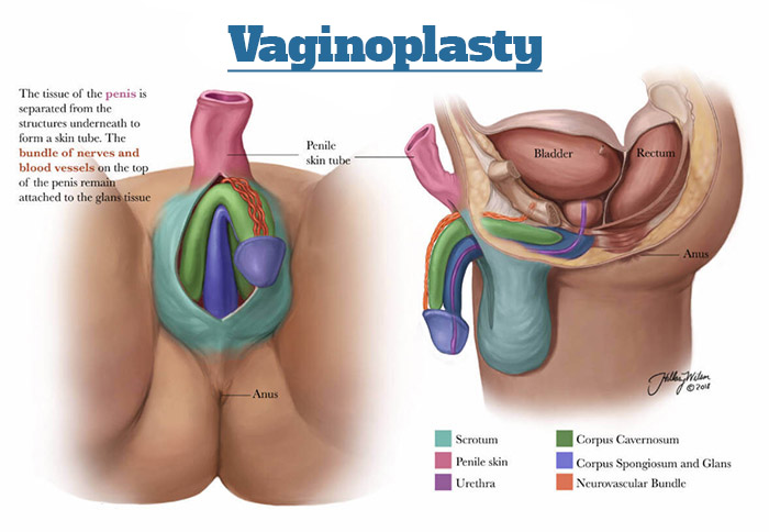 Vaginoplasty