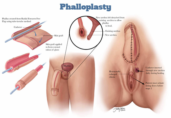 Phalloplasty