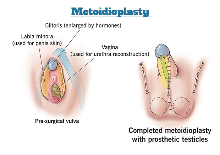 Metoidioplasty