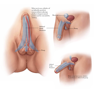 A Guide To FTM What Is PenilePlasty-Cover Image