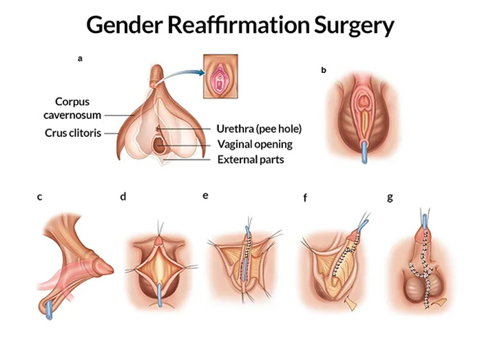 Is Gender Reassignment Surgery Required To Become Transgender?