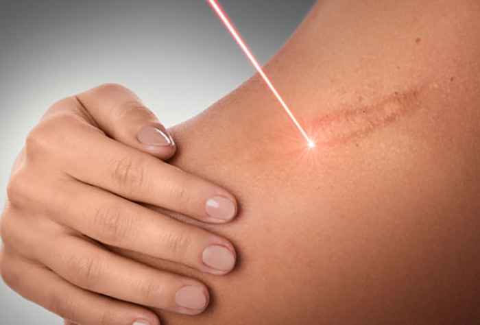 Laser Scar Removal