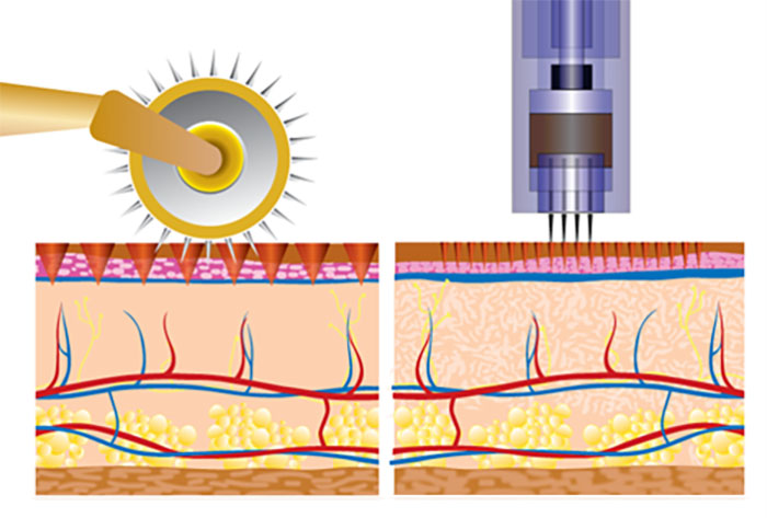 Medical Needling