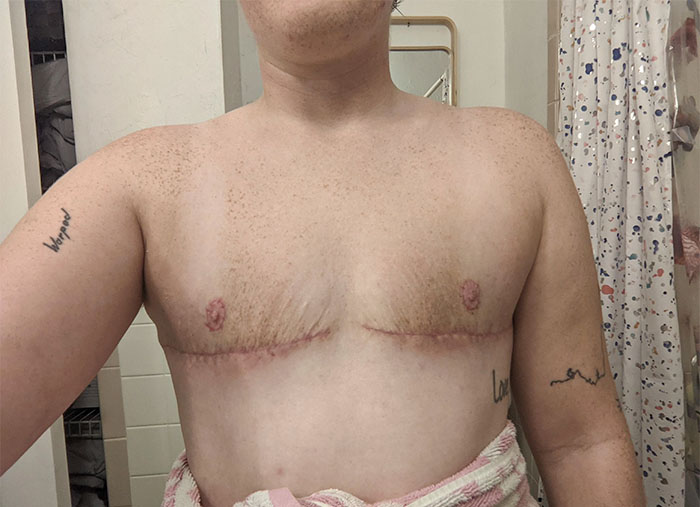 FTM Top Surgical Scars