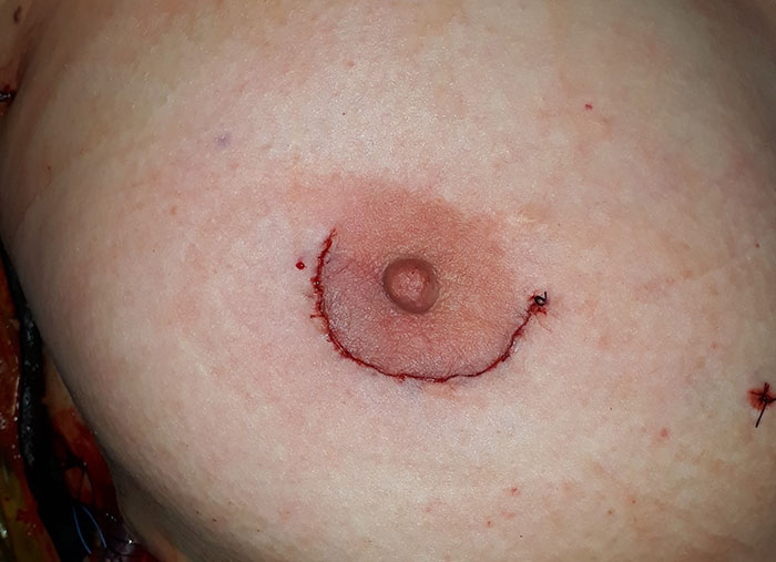 Peri-Areolar Incisions