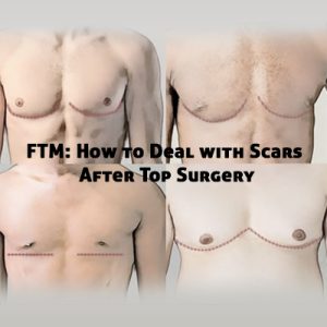 FTM- How to Deal with Scars After Top Surgery- Cover Image