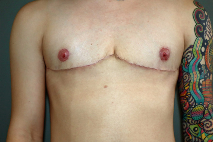 Double-Incision Top Surgery with Nipple Grafts
