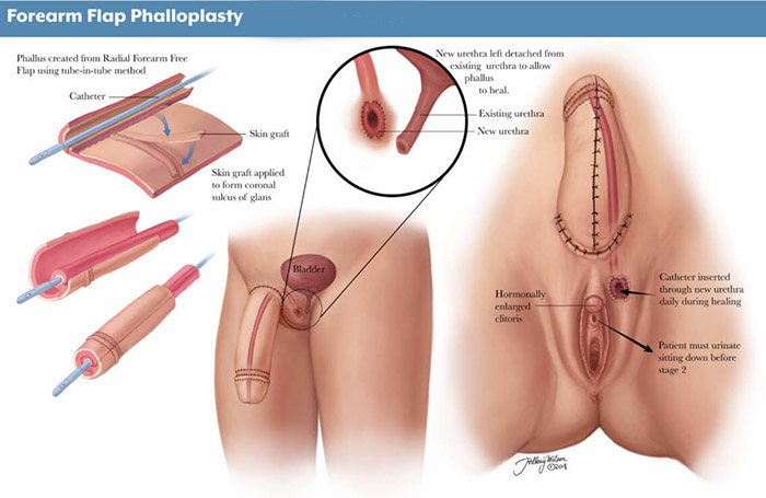 Phalloplasty