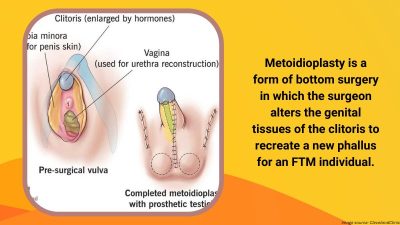  Understanding FTM Bottom Growth - Signs, Process, and FAQs