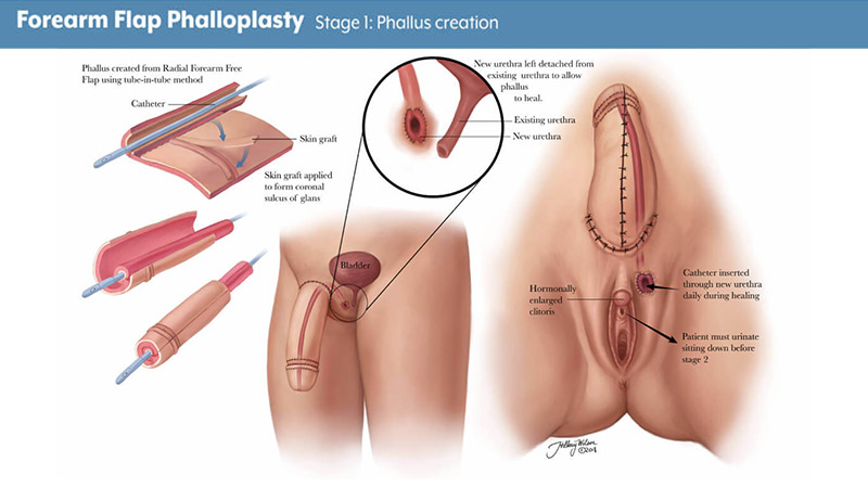Does a Phalloplasty Get Erect? Insights and Experiences for Transmen