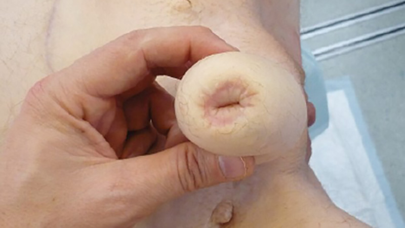  Does a Phalloplasty Get Erect? Insights and Experiences for Transmen