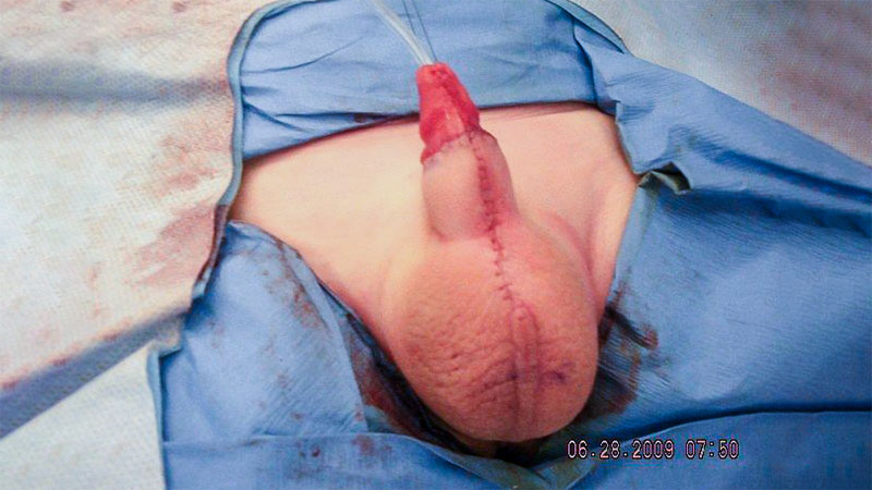  Does a Phalloplasty Get Erect? Insights and Experiences for Transmen