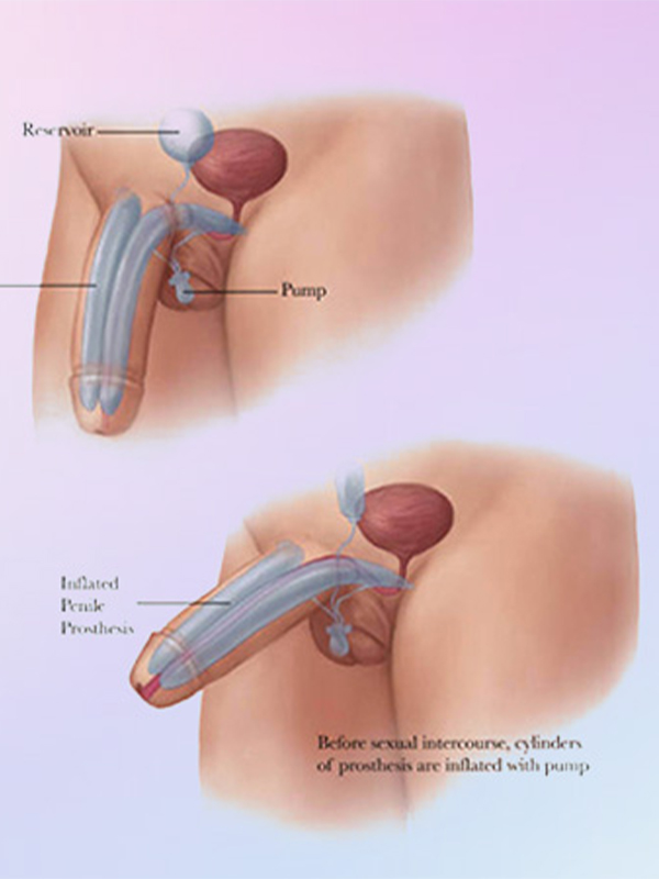 Does a Phalloplasty Get Erect? Insights and Experiences for Transmen