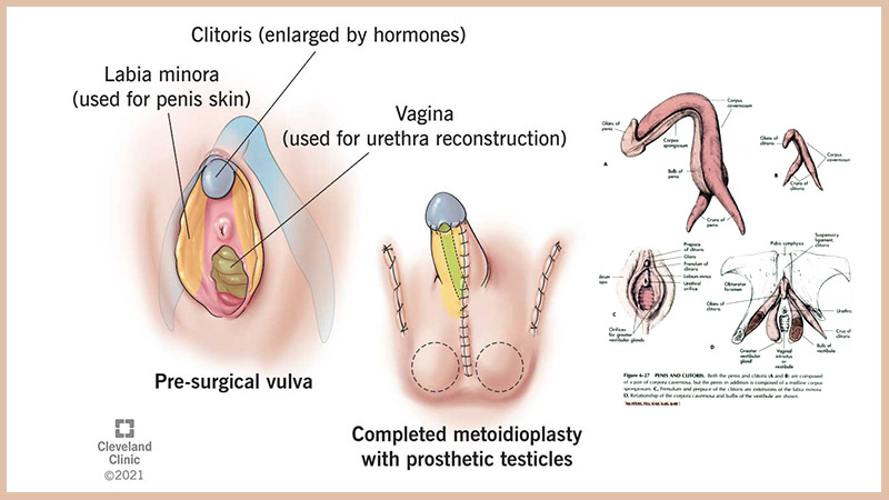 How Much Does FTM Bottom Surgery Cost?