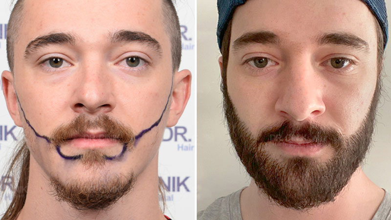 FTM Beard Growth Guide: Methods, Tips, and Personal Experiences