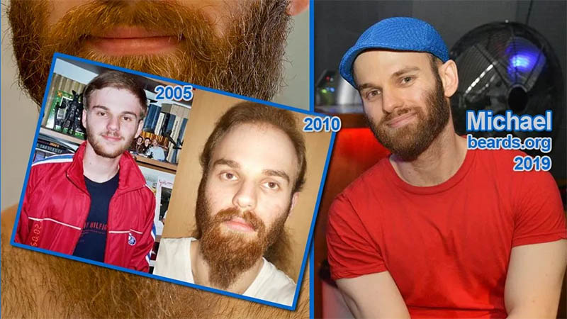 FTM Beard Growth Guide: Methods, Tips, and Personal Experiences