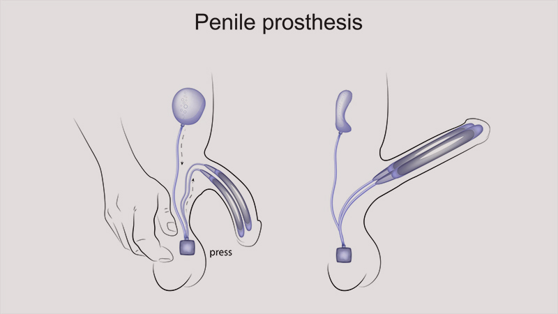 How Does a Trans Man Get a Penis
