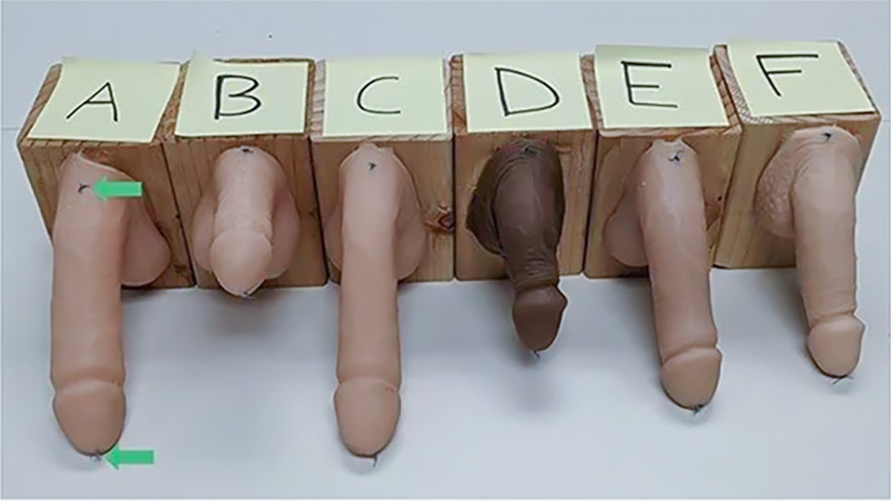 How Does a Trans Man Get a Penis
