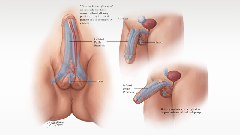 How Does a Trans Man Get a Penis