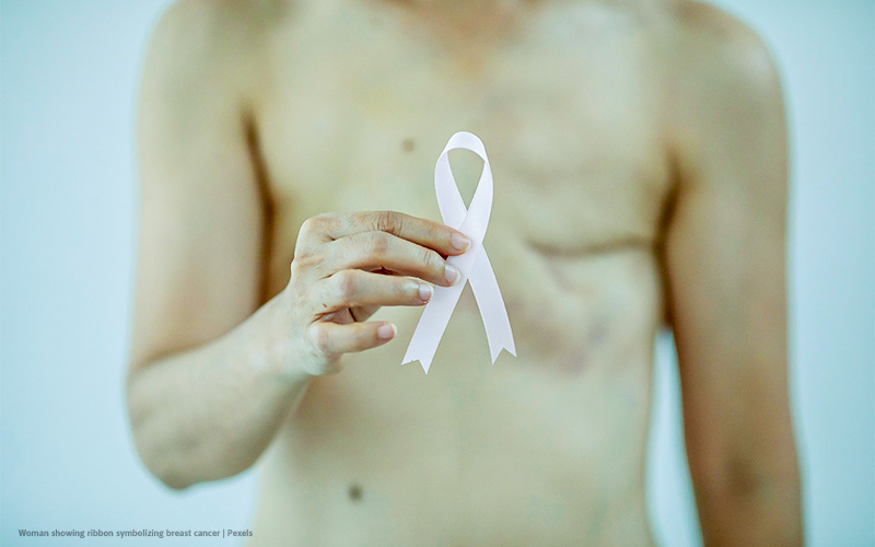 Are Transgender Men at Risk for Breast Cancer