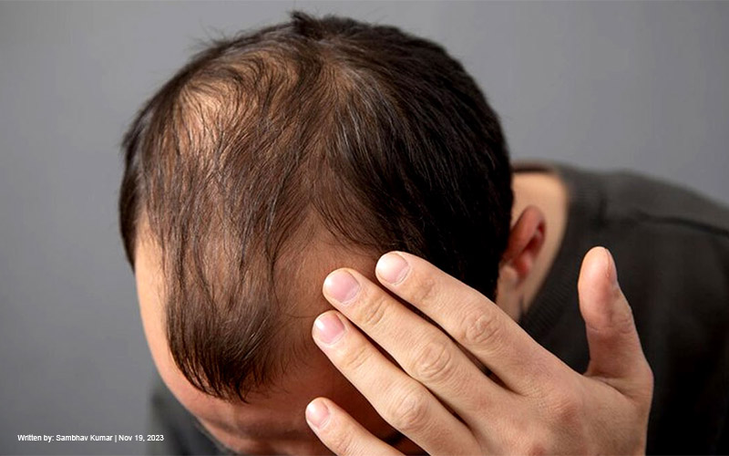 FTM Hair Loss: Understanding and Managing Balding on Testosterone