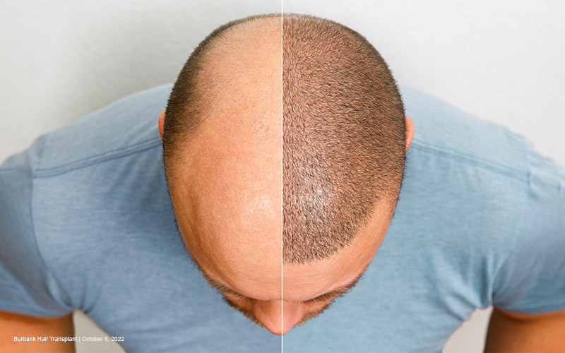 FTM Hair Loss: Understanding and Managing Balding on Testosterone