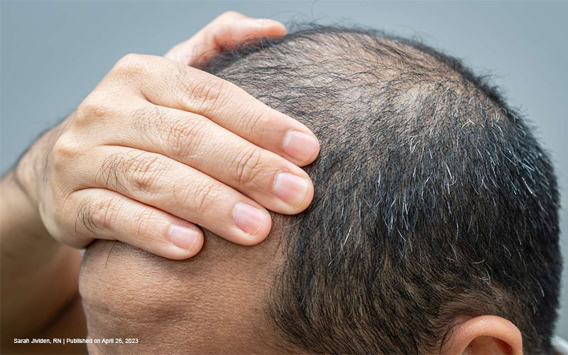 FTM Hair Loss: Understanding and Managing Balding on Testosterone