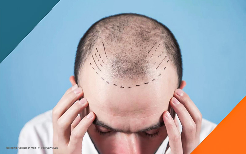 FTM Hair Loss: Understanding and Managing Balding on Testosterone