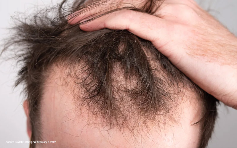 FTM Hair Loss: Understanding and Managing Balding on Testosterone