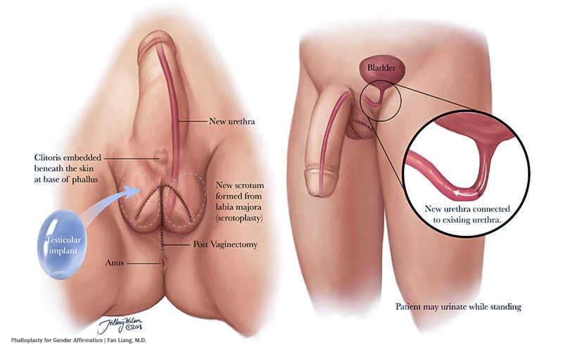 A Guide to FTM Sexual Health with a Focus on Post-Transition Care