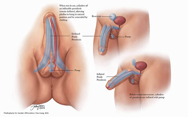 A Guide to FTM Sexual Health with a Focus on Post-Transition Care