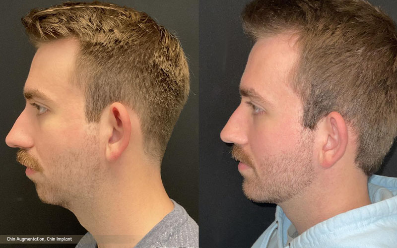 How to Achieve a More Defined Jawline