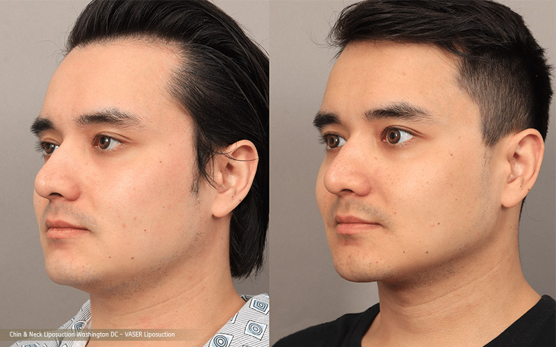 How to Achieve a More Defined Jawline