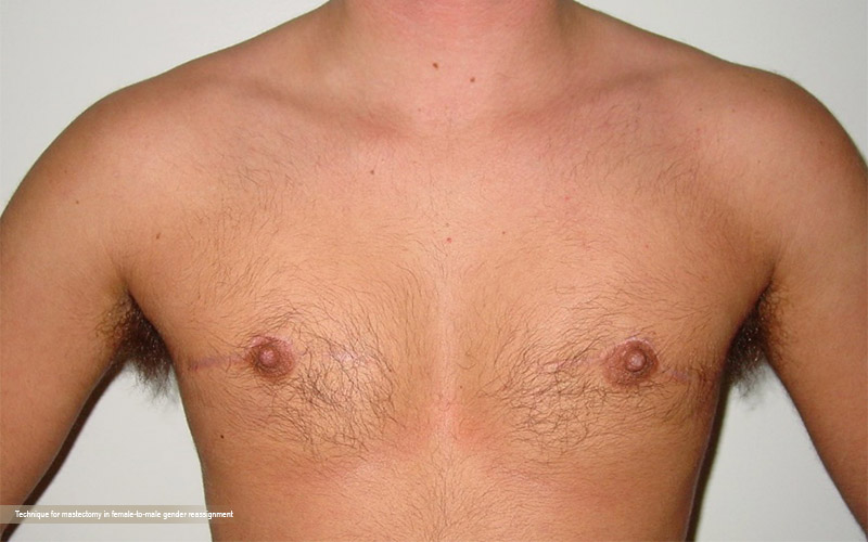 Transgender Mastectomy: Understanding the Process