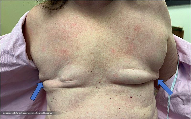 Transgender Mastectomy: Understanding the Process