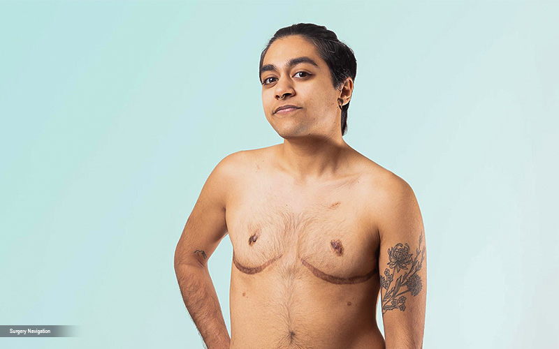 Transgender Mastectomy: Understanding the Process