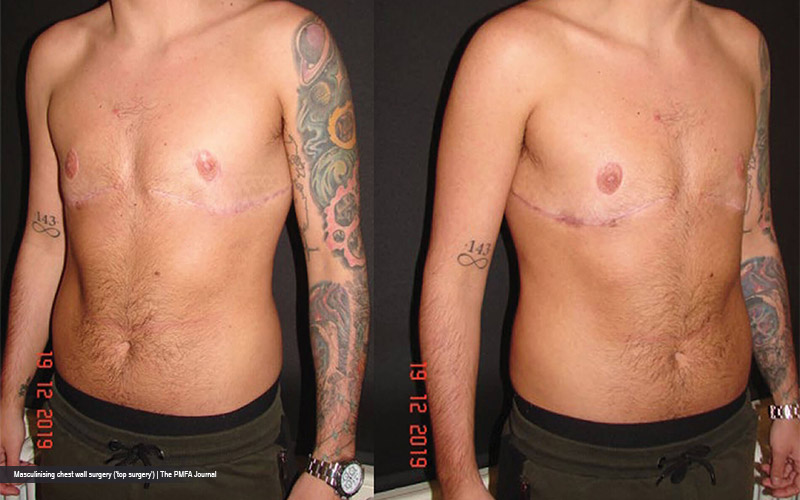Transgender Mastectomy: Understanding the Process