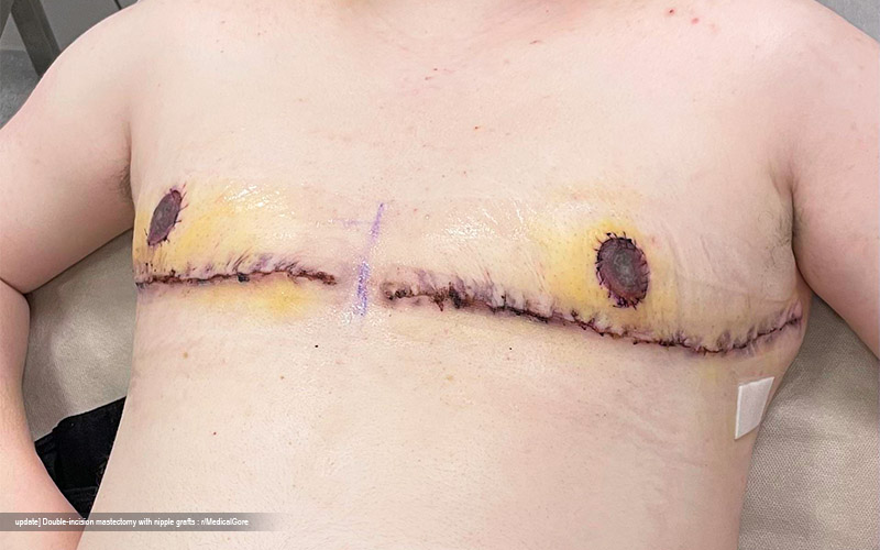 Transgender Mastectomy: Understanding the Process