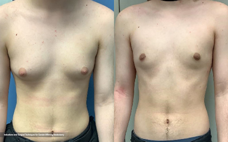 Transgender Mastectomy: Understanding the Process