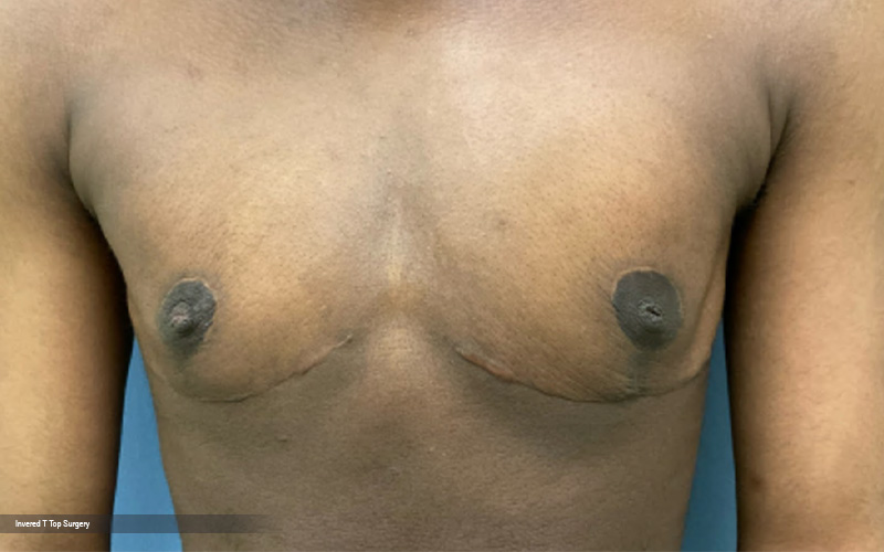 Transgender Mastectomy: Understanding the Process