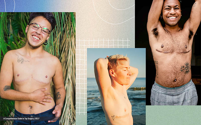 Transgender Mastectomy: Understanding the Process