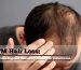 FTM Hair Loss: Understanding and Managing Balding on Testosterone